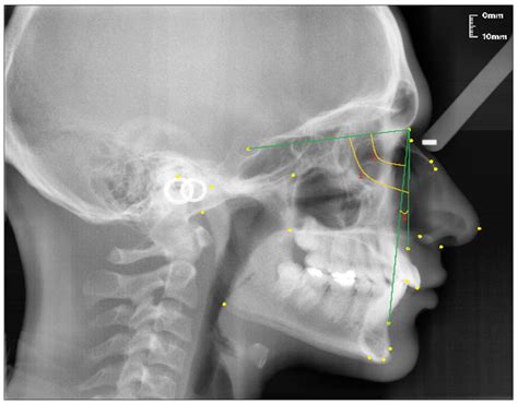 nose stl x ray meaning|Nasal Bones X.
